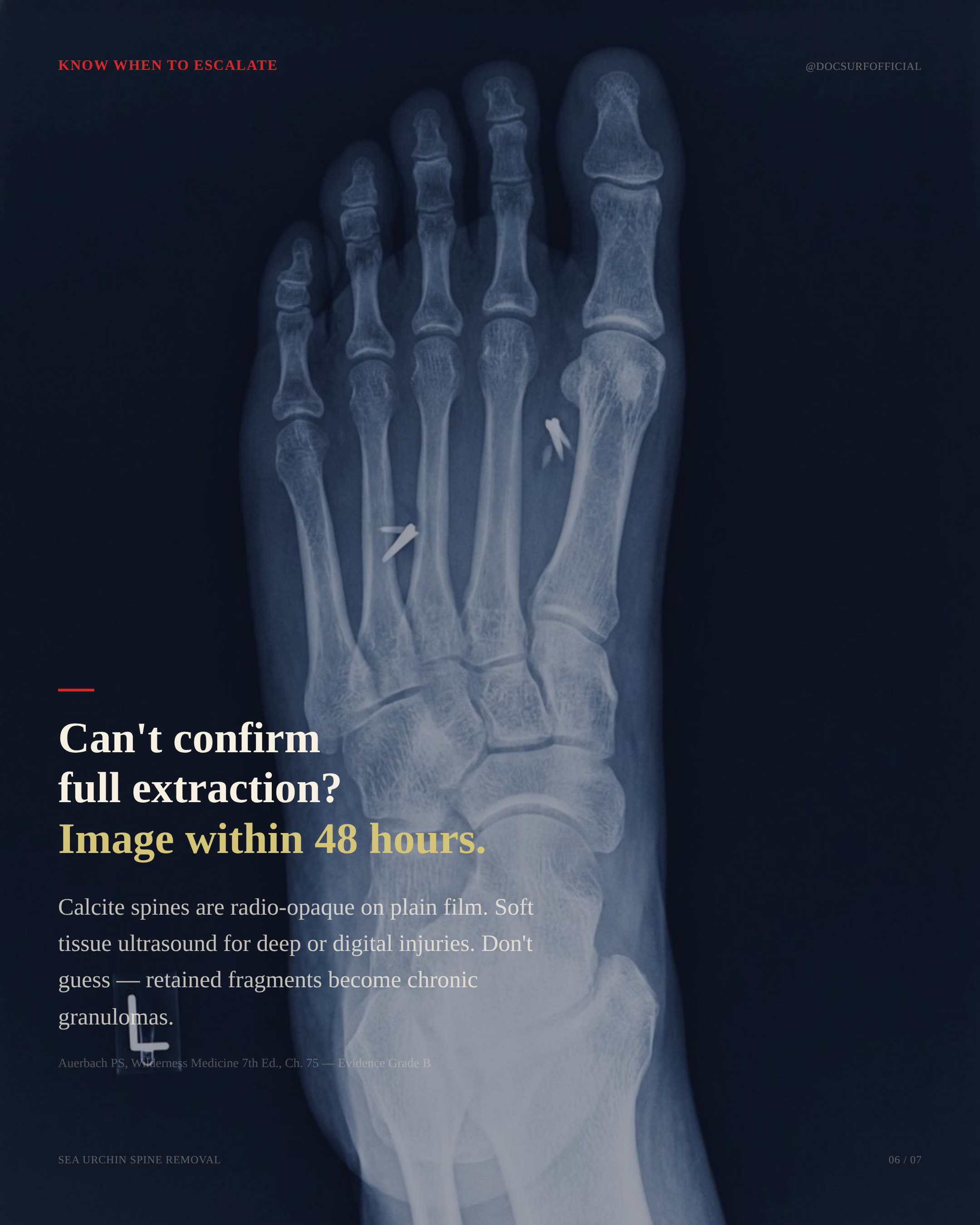 Plain film x-ray of a foot showing radio-opaque retained sea urchin spine fragments. Surf Intel slide: 'Can't confirm full extraction? Image within 48 hours.'
