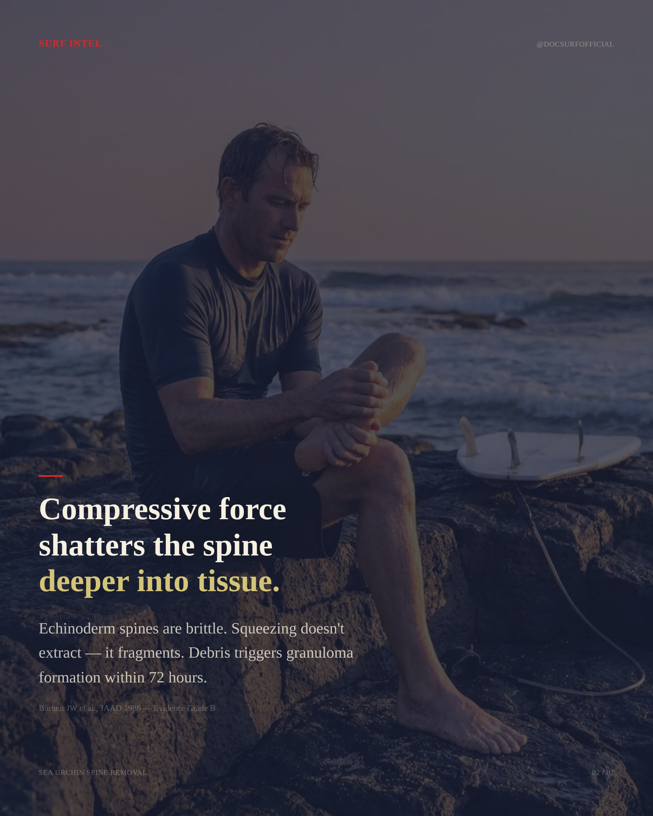 Surfer inspecting a foot on coastal rocks at dusk. Surf Intel slide: 'Compressive force shatters the spine deeper into tissue.'