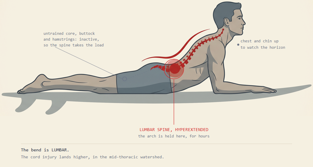 Diagram of a surfer lying prone on a board with the lower back arched, showing load concentrated at the lumbar spine while the core, buttock and hamstring muscles remain inactive.