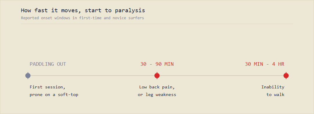 Timeline showing three points: paddling out on a first session, low back pain or leg weakness at 30 to 90 minutes, and inability to walk 30 minutes to 4 hours later.