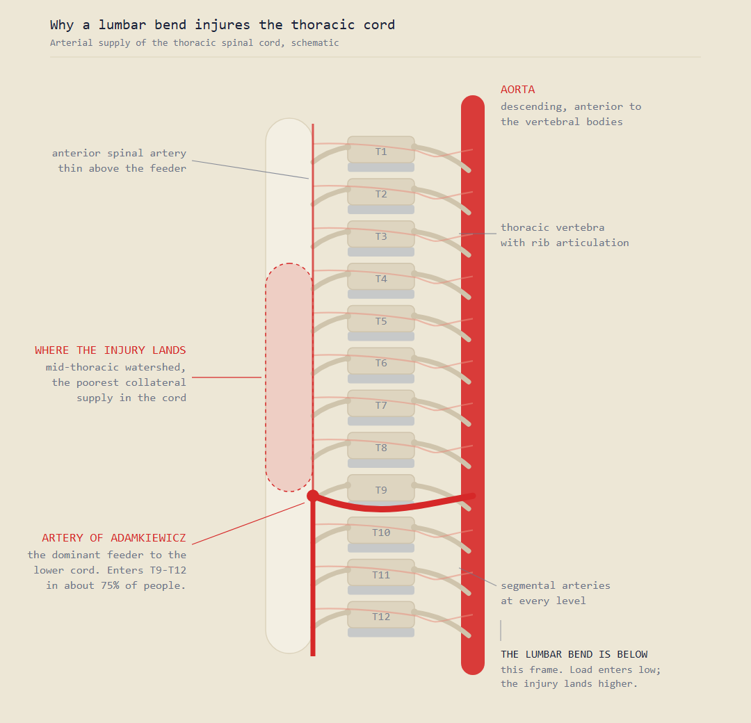 Schematic of the thoracic spinal cord blood supply showing the aorta, an intercostal artery, the radicular artery, the artery of Adamkiewicz joining the anterior spinal artery, and the watershed zone of the mid-thoracic cord.