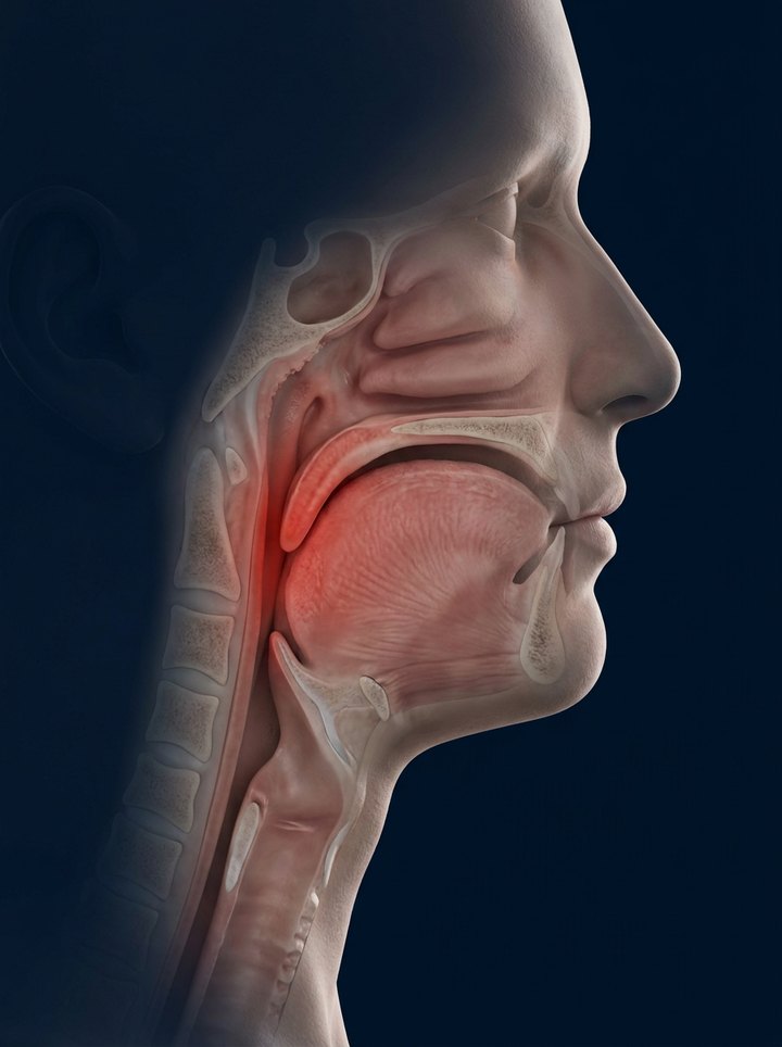 Anatomical cross-section of the head and neck showing the upper airway sealed shut by the collapsed tongue and soft palate, the blocked tissue tinted vermillion.