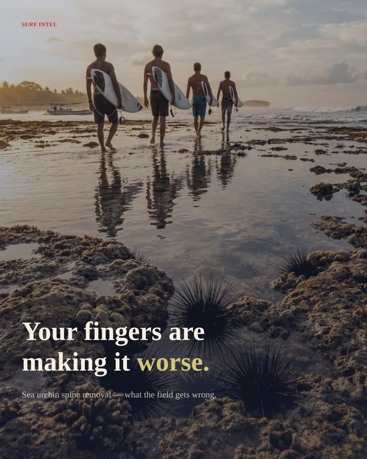 Surf Intel cover slide for Sea Urchin Spine Removal — 'Your fingers are making it worse.'